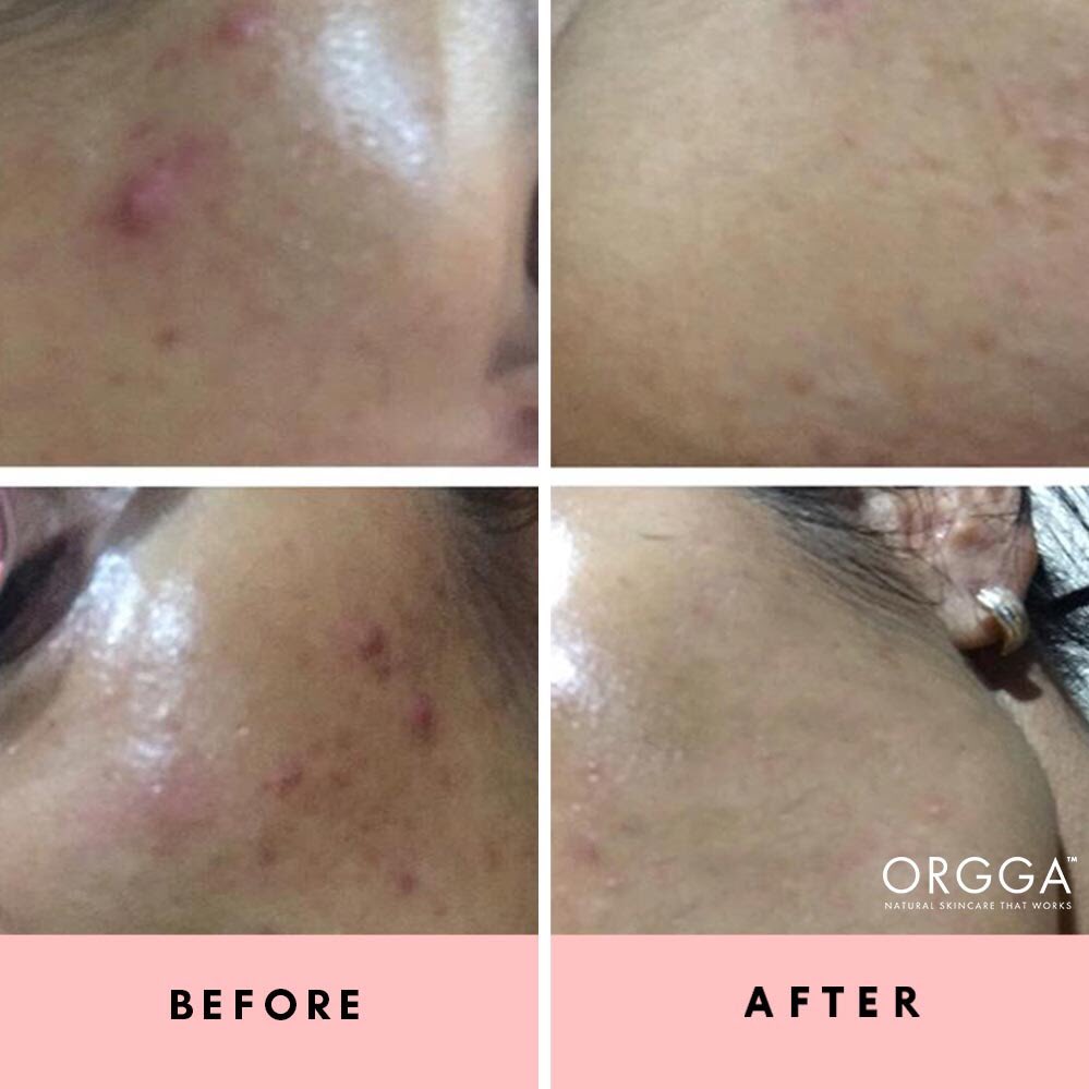 OrggaMalaysia's tweet photo. #OrggaFeedback | "Jerawat dah kurang walaupun masih ada sikit2 lagi" - sis Suhaila . Lindo Basic Set memang sangat sesuai untuk orang kulit berminyak dan berjerawat 😘 https://t.co/GPcdE0m71c