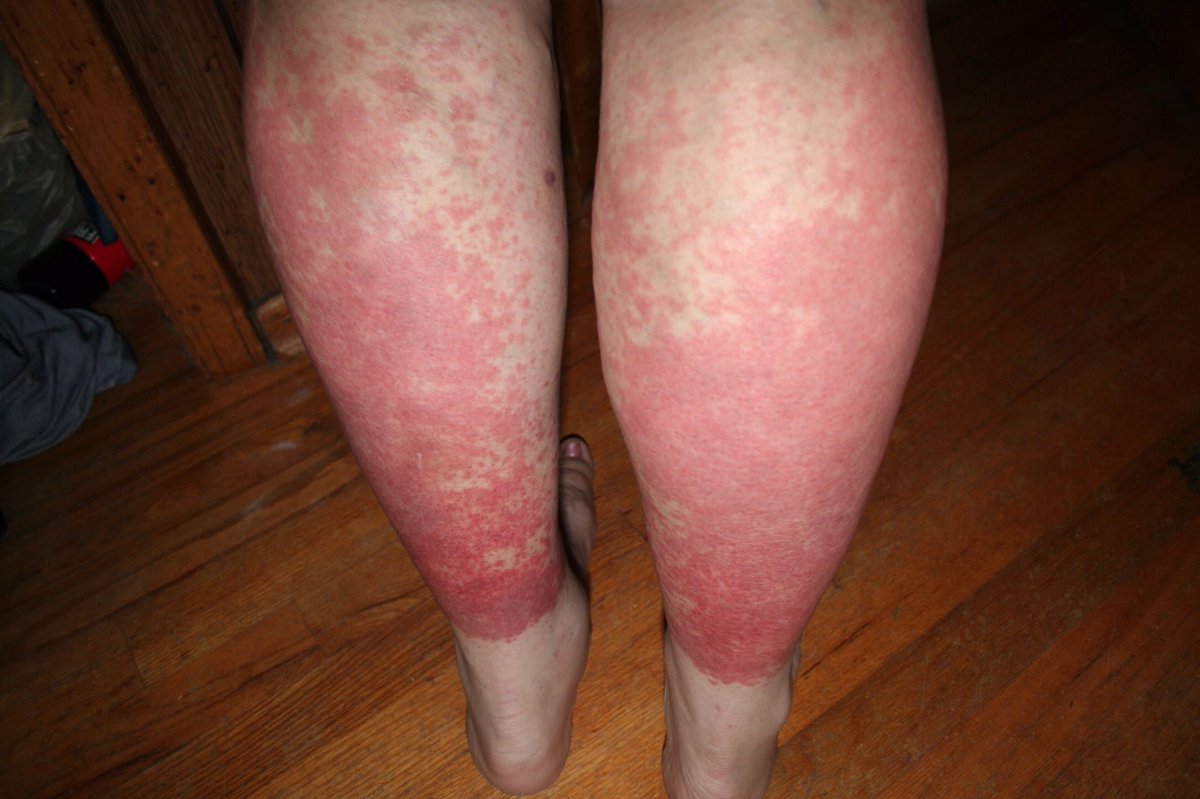 AA7RT's tweet image. 2006. I had been on HYDROXYCHLOROQUINE for my rheumatoid arthritis. I started losing a lot of hair (On my head) and the doctor took me off the medicine. Two months later, I went outside for less than 10 minutes to cut my grass. I had a reaction to the sun, photo sensitivity......