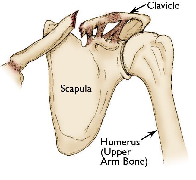 When the bone breaks the pull of the muscle causes a dislocation of the medial fragment which can even result in perforation of the bone fragment through the skin. The typical trauma which causes a clavicle fracture is a fall on the shoulder or a fall with your outstretched hand