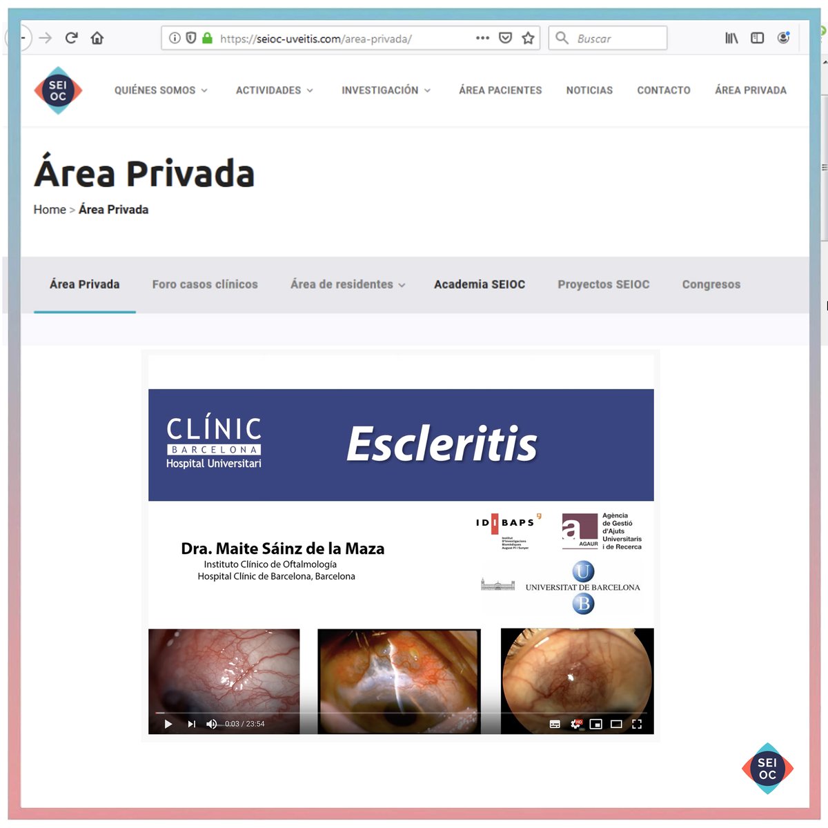 Ya está a disposición de todos los socios en el área privada de nuestra web (sección #AcademiaSEIOC)la charla sobre #escleritis de la doctora Sainz de la Maza; ¡Aprovecha estos días de confinamiento para avanzar en el conocimiento de esta enfermedad!

#sociosSEIOC