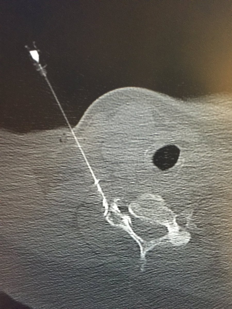 Day 5 @NHSHarlow. Our #irad team perform CT guided spinal injections for pain management. Service is popular with our patients &amp; supported by our spinal surgeons. Photos 1)cervical interlaminer epidural 2) thoracic transforaminal 3) SIJ 4) cervical transforaminal. <a href="/ZaidAHAldin1/">Zaid A H Aldin</a>
