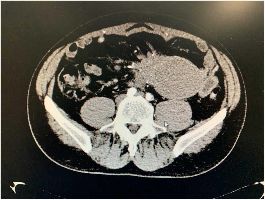 Adenocarcinoma sobre quiste de duplicación yeyunal dlvr.it/RSHbhv