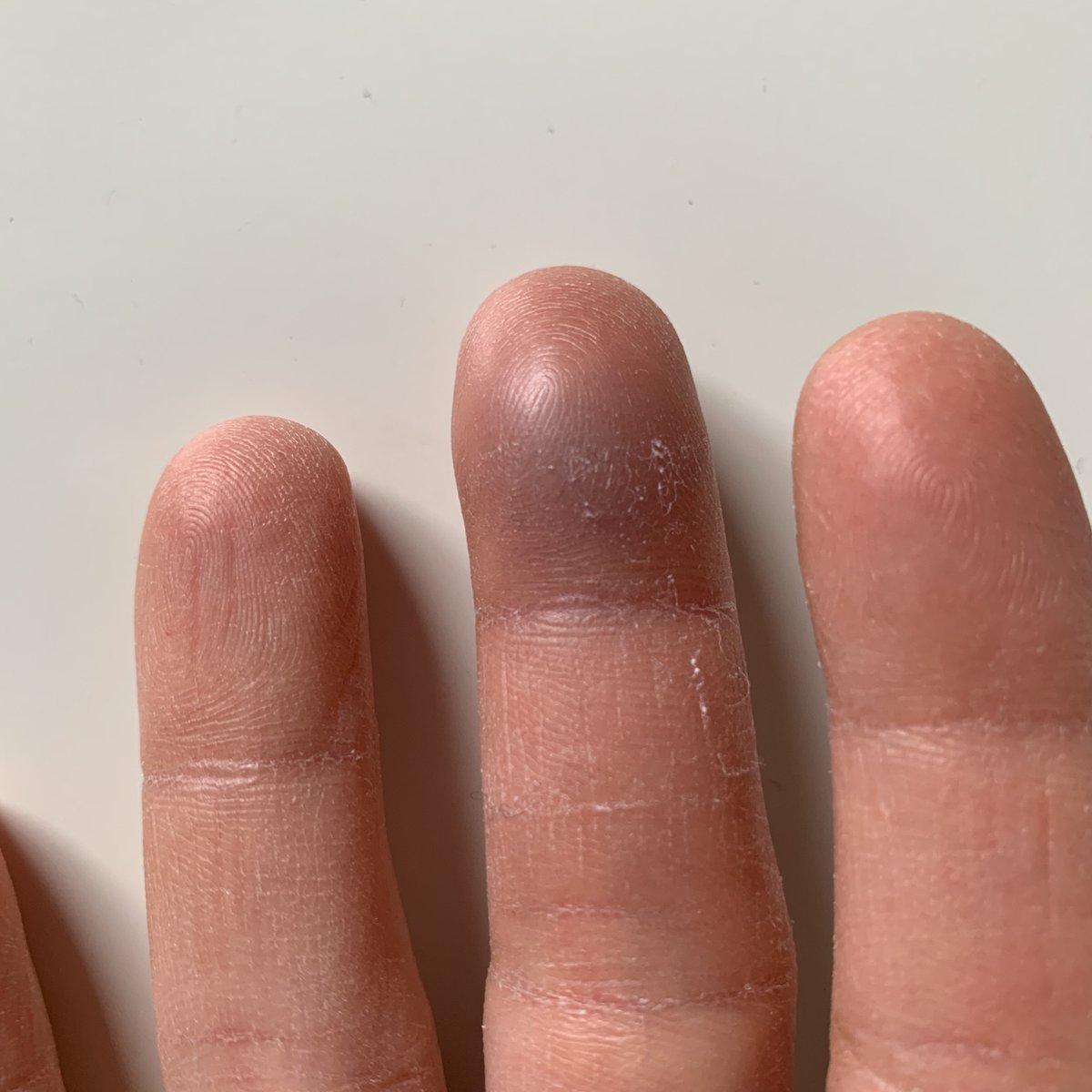 Finger geklemmt nagel blau