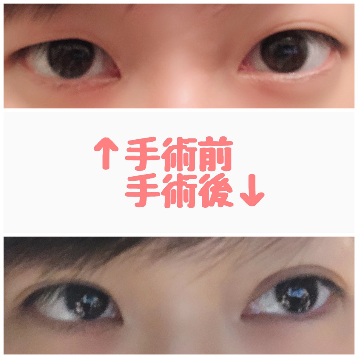 つづ 埋没経過 Tzflowertz Twitter