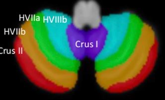 ACNPorg's tweet photo. Study of >17k individuals identified associations of cigarette smoking with global and specific gray &amp; white matter regions after controlling for confounders (e.g., alcohol use), highlighting potential mechanisms of risk for common neurological sequelae. @JoshChGray @MaxMOwens https://t.co/m4AdYKVRb6