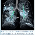 いくつかのツイート、『医者が「スリガラス陰影(間質影)」と肺炎になっ 