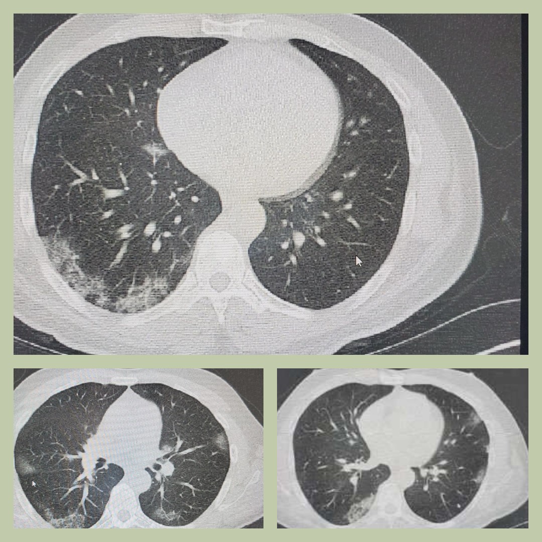 I m a Cardiology fellow, NY, no PMH, fighting COVID infection 4 a week. Fevers, cough -> wheezing/SOB, on Hydroxychloroquine+Azithromycin, got worse on 2nd day of it, now in MICU. Got iv Tocilizumab, hoping to improve @GileadSciences @Roche @FYang_EP @CMichaelGibson @ACCinTouch