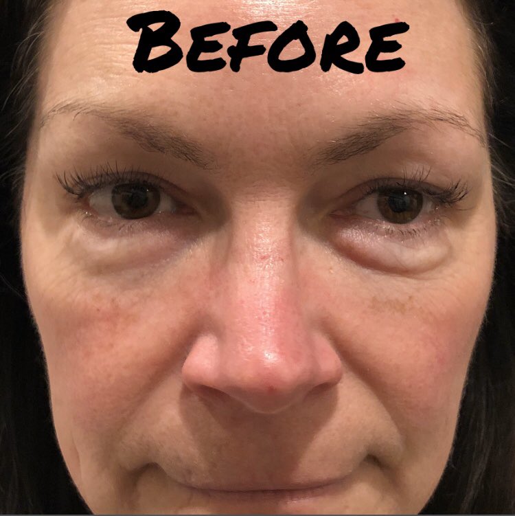 ClinicalSusan's tweet photo. BOOM! That’s what I’m talking about! @PlasmaPen
#plasmapen #fibroblast #skintightening #skincare #tulsa #tulsaoklahoma #caotulsa https://t.co/pRqb2QDNTA