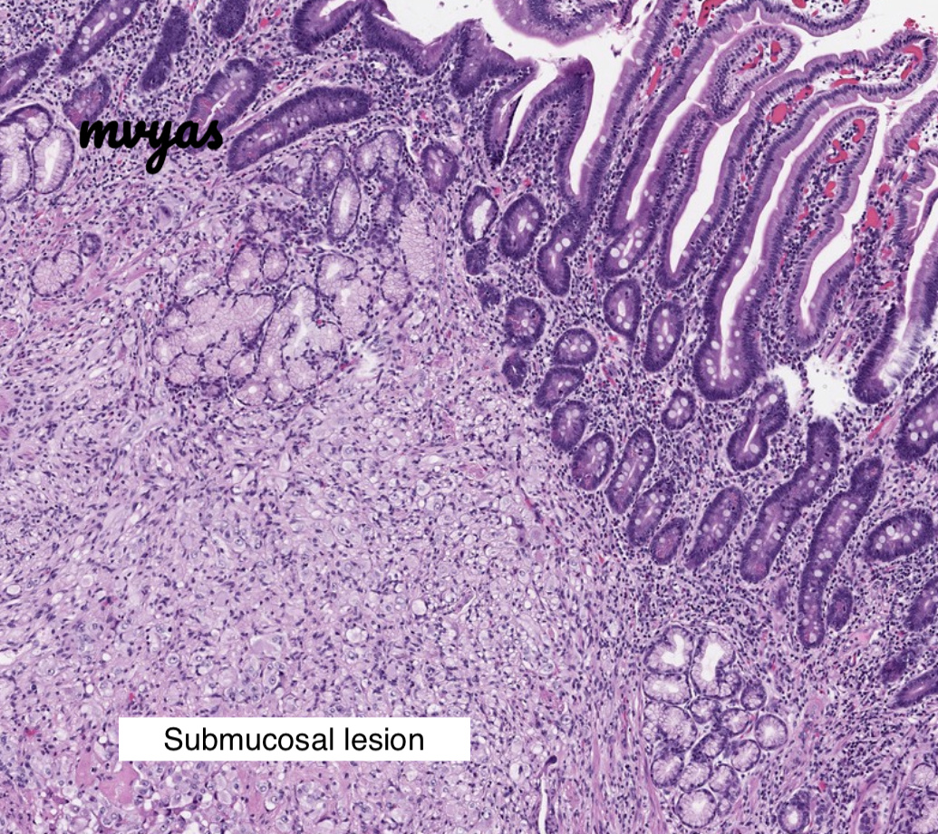 Mvgs1706's tweet photo. Gangliocytic paraganglioma (GPG) - perhaps one of the most enigmatic pathology entities!
Classic location - D2/periamp (rarely spinal cord)
EGD  - nodule/bump 
Histo- 3 components - 
1. Endocrine - carcinoid/paraganglioma-like
2. Schwannian/spindle cell
3. Ganglion cells
#GIpath https://t.co/HdYVFMeNkb