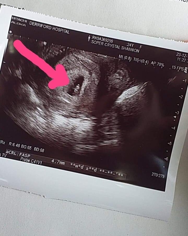 css0995's tweet photo. Hello little bean 🤰🥰 we cant wait to meet you, I love you so much already and you're not even here yet ❤ keep wriggling away, 20 weeks down, 20 to go! #dueinaugust #babyscan https://t.co/nax7lNbv6R