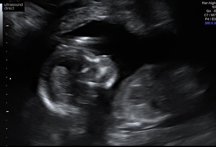 css0995's tweet photo. Hello little bean 🤰🥰 we cant wait to meet you, I love you so much already and you're not even here yet ❤ keep wriggling away, 20 weeks down, 20 to go! #dueinaugust #babyscan https://t.co/nax7lNbv6R