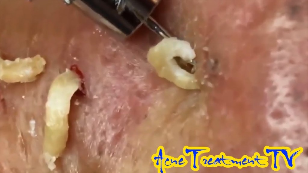 duralytikcom's tweet image. Acne Treatment Skincare #acne #blackheads#whiteheads, #Treatments #pimple#komedon #2Full Screen HD duralytik.com/acne-treatment…