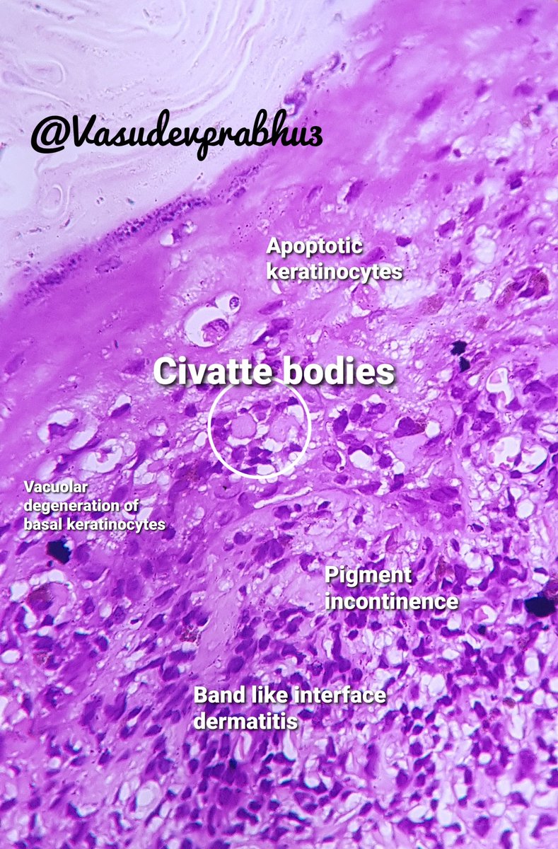 DrVasudevPrabhu's tweet photo. Lichen planopilaris. Classical example.
🔬Wedge shape hypergranulosis
🔬Dense Interface type infiltrate
🔬Keratotic Plugging of hair follicles
🔬Civatte bodies
#dermpath #skinbiopsy #dermatopathology #dermatology @DermpathUAMS @pathologistmag @TexPathol #pathboards https://t.co/5rjvWZIBxn