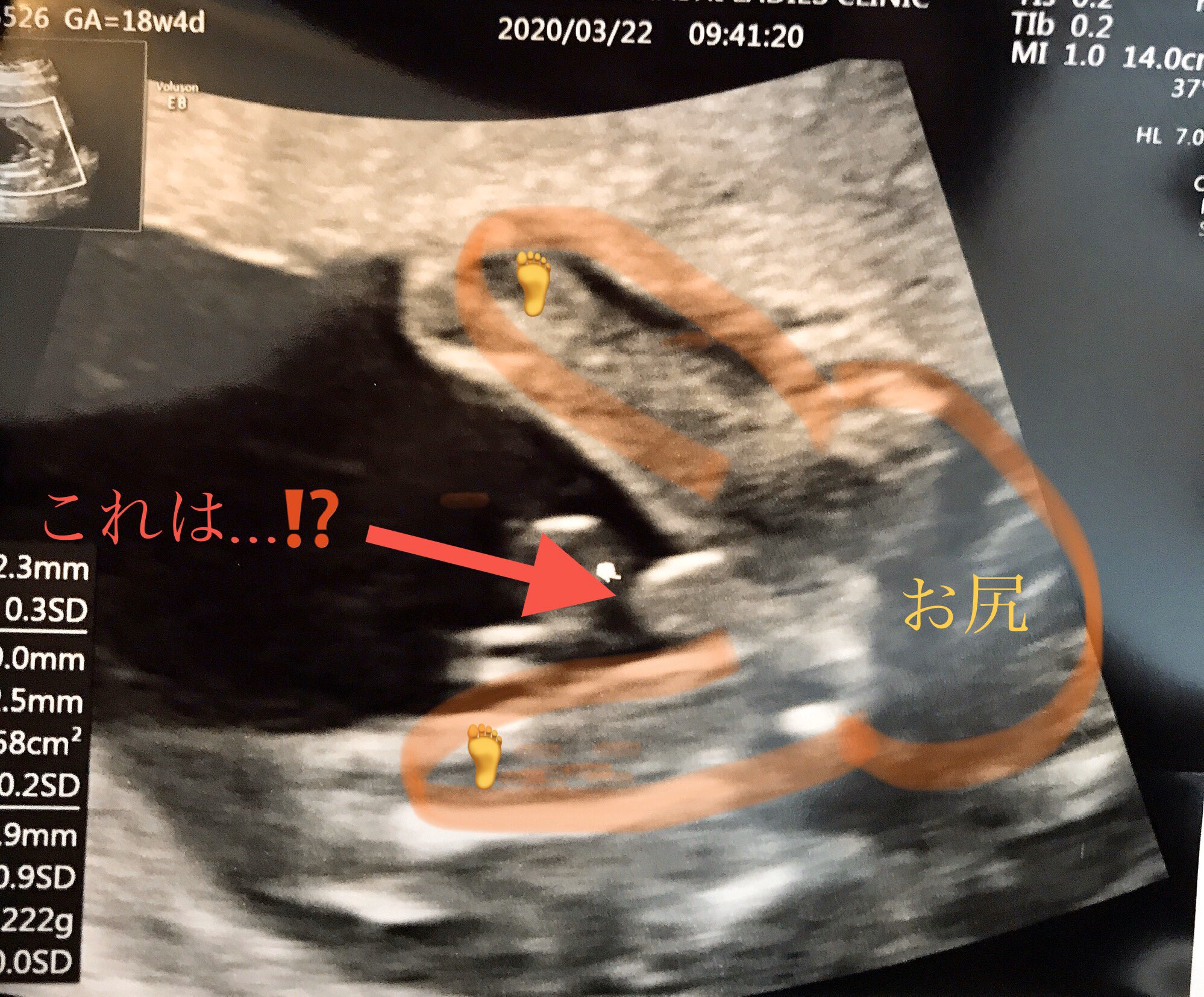 ホシユカ 自分の運気を知ろう 男の子 女の子 今日は健診の日でした ガラスの上に赤ちゃんを乗せて下から覗いたみたいな感じがこれ この真ん中のものはまさか 妊婦 健診 5カ月 18w T Co Raw0anvndc Twitter