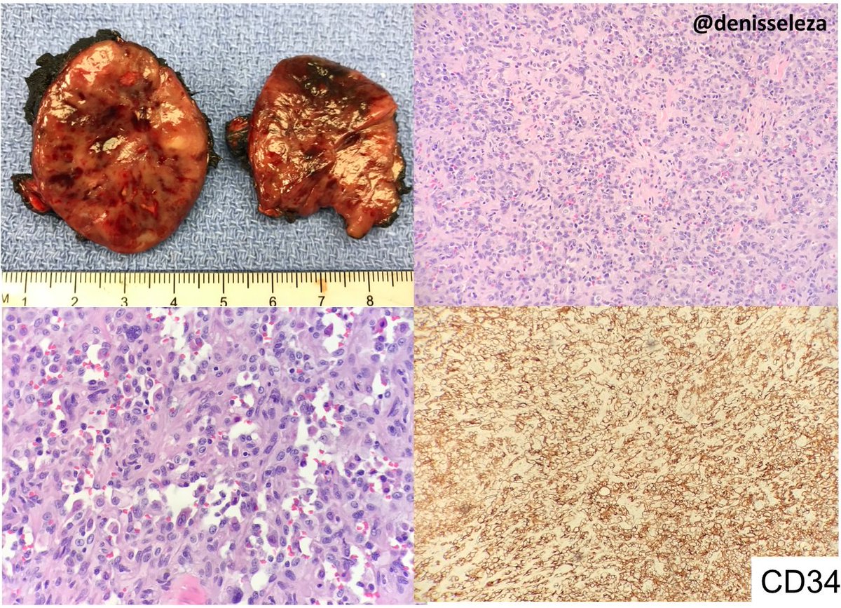 TexPathol's tweet photo. Epithelioid hemangioendothelioma: 5.5 cm mass, solid cut surface. H&amp;E: large epithelioid cells with enlarged, vesicular nuclei and abundant eosinophilic cytoplasm. Anastomosing vascular spaces are also present. Tumor cells diffusely positive for CD34, CD31 and TFE3 https://t.co/zkWybCCeeK