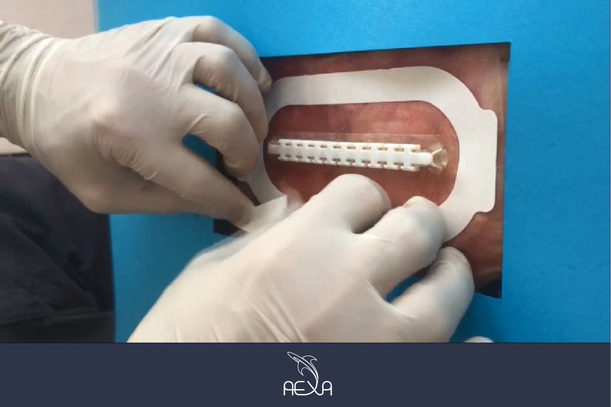 aexa_tv's tweet image. A new method for wound #suturing arrives, we are talking about #INCLODE.👨‍🔬

 The device looks like a patch with a closure in the middle, and has a foil that adheres to the #skin before beginning surgical #surgery to improve the suture. 

#IMIRP2020AEXA   #AEXAEducation