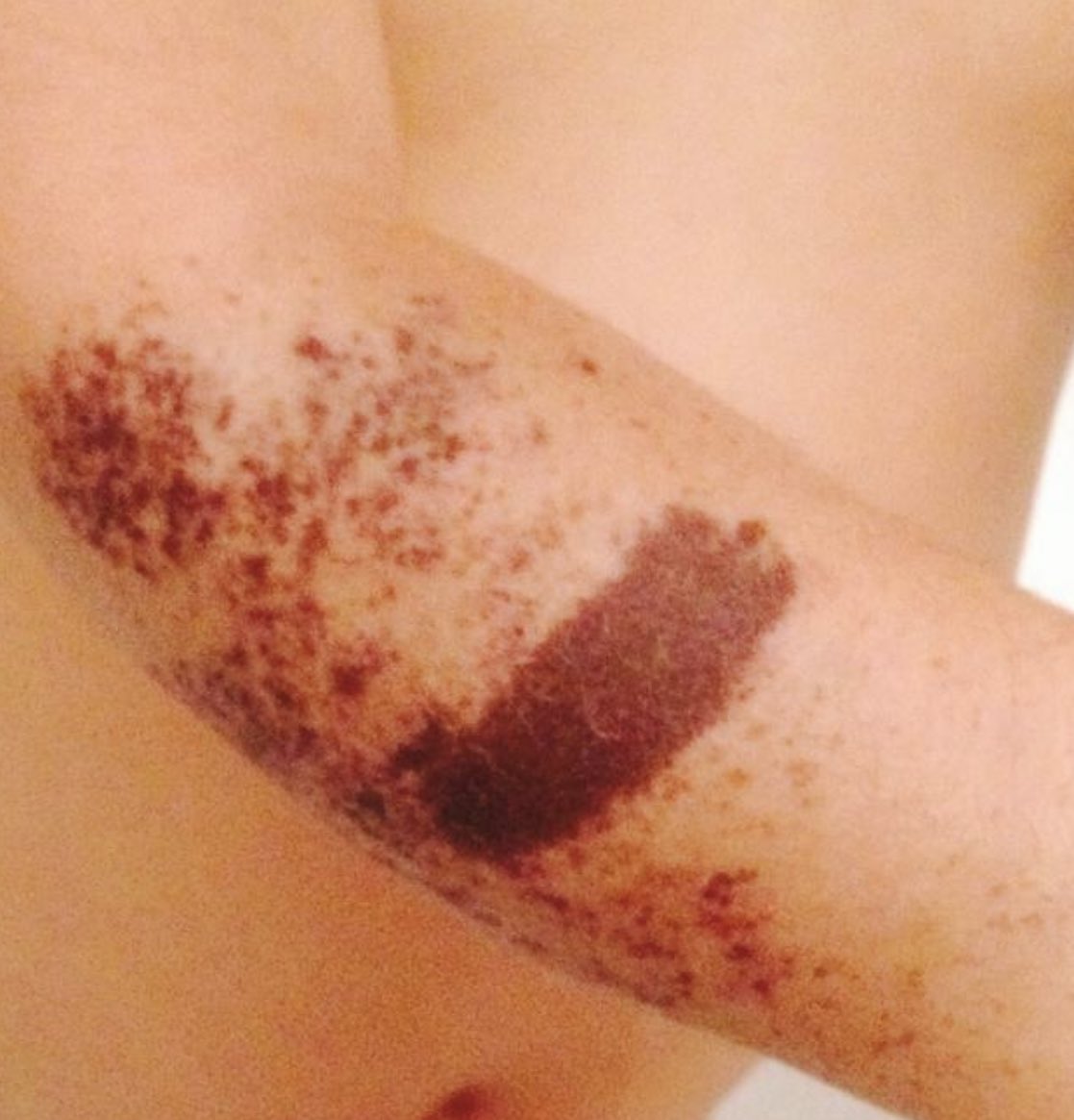 Tae 11y2y そろそろ出産する方も増えるので 後悔の意味も込めてまとめておきます ก 赤ちゃん 子供の痣について 知らずに後悔され方が1人でも少なくなりますように 写真は1歳児の時です T Co 5gx7pgouxa Twitter Tae 11y2y そろそろ出産する方も増えるので 後悔の意味も込めてまとめておきます ก 赤ちゃん 子供の痣について 知らずに後悔され方が1人でも少なくなりますように 写真は1歳児の時です T Co 5gx7pgouxa Twitter