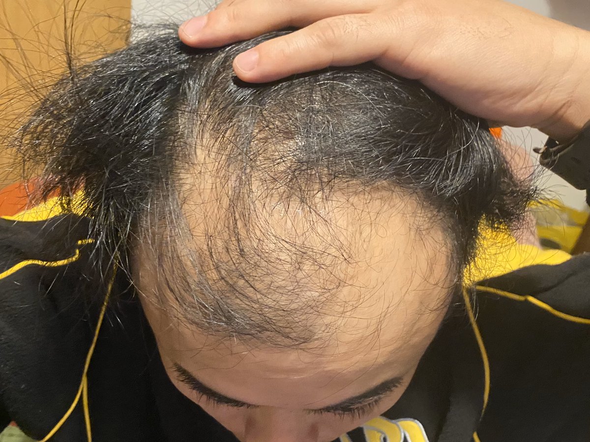 ノボせもんなべ 100日後に死ぬ毛根 1日目 ノボせもんなべ 100日後に死ぬ毛根 1日目