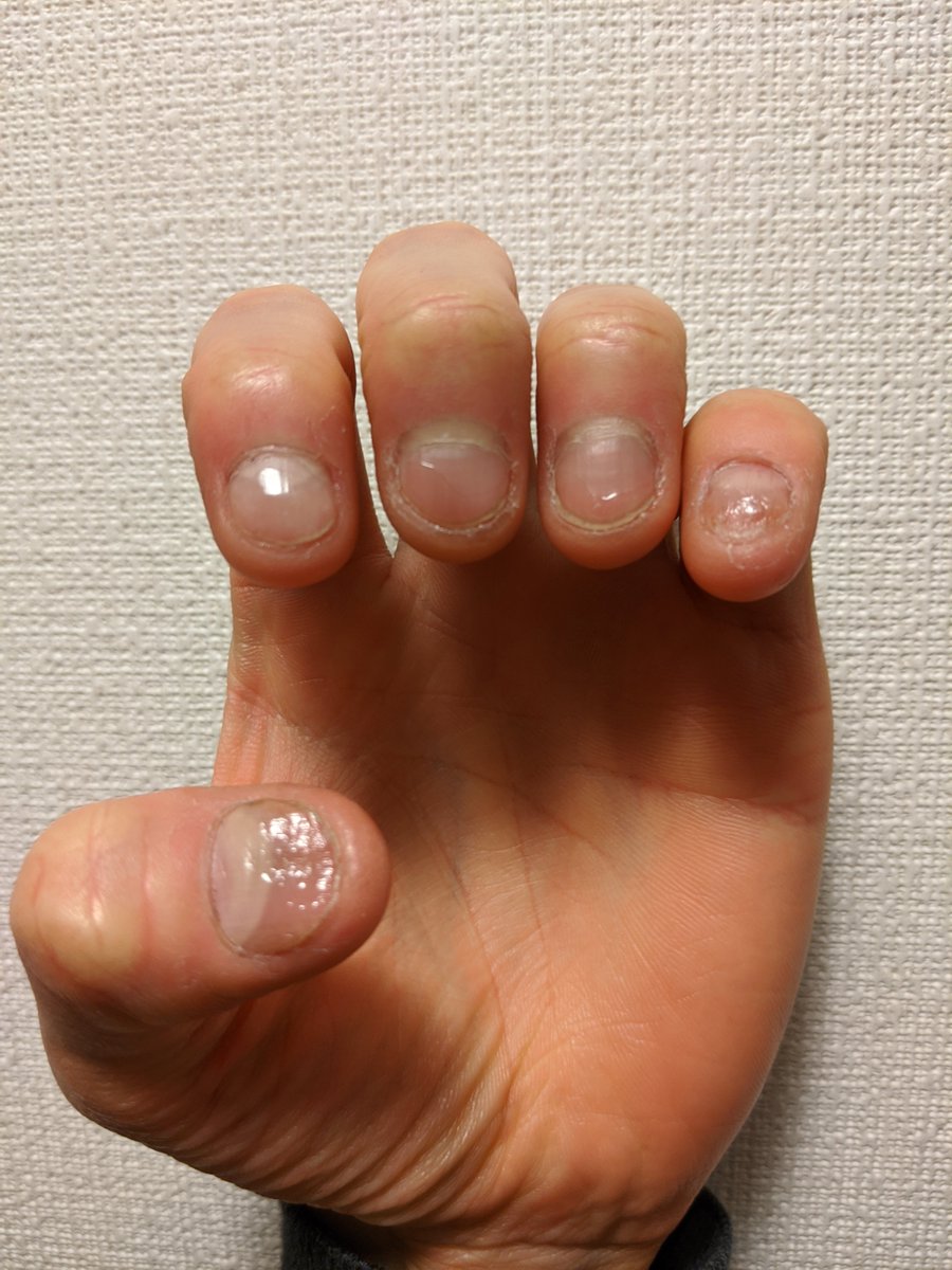 爪噛み男 Nail Biter 23日目 ほぼ無傷 デュカートの自爪補強コート塗ったらツルツルして触り心地よいから Day 23 Almost No Biting Ducato Nail Base Made Nails Smooth 爪噛み克服 Stopnailbiting T Co Jorknyzatf
