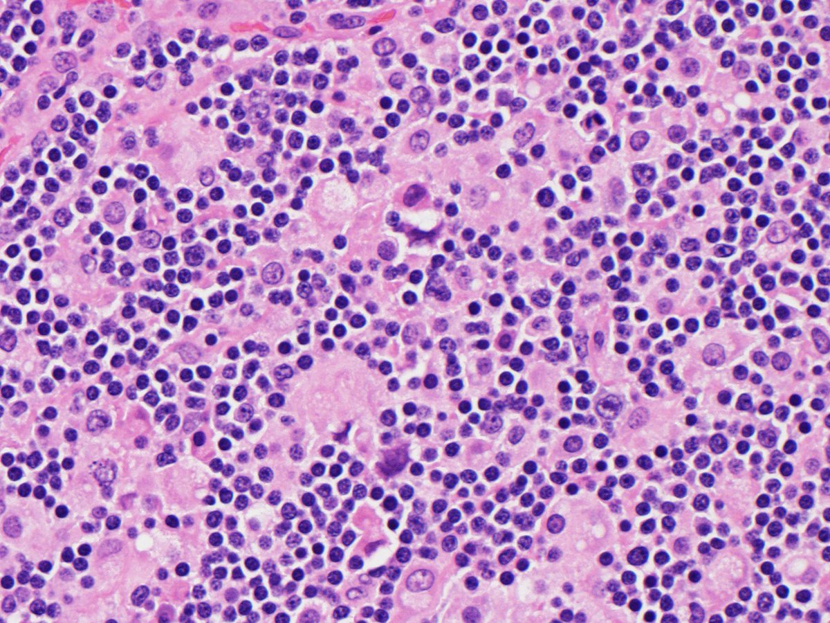 Young person with enlarged cervical LN. what immunostains would you order? #pathology #VirtualPath #hemepath