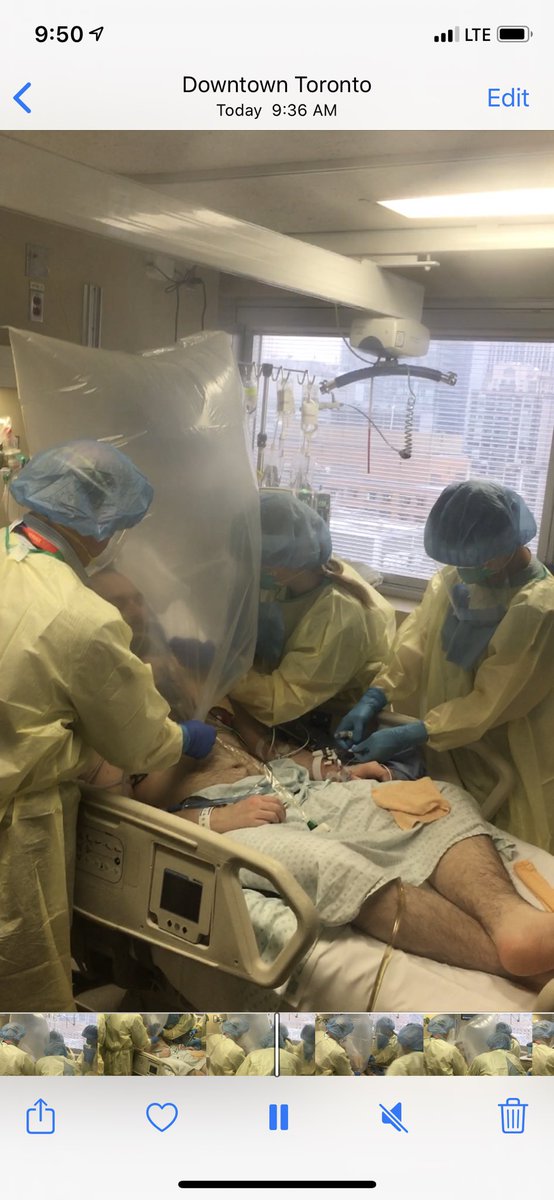 (With permission)
Extubation #COVID19 patient inside a large plastic bag to contain cough. Bag prefilled with Heliox to keep it open. Pulled behind patient to below shoulders. Tavish mask in bag. ETT pulled from outside bag, kept inside bag, air evacuated by suction after.