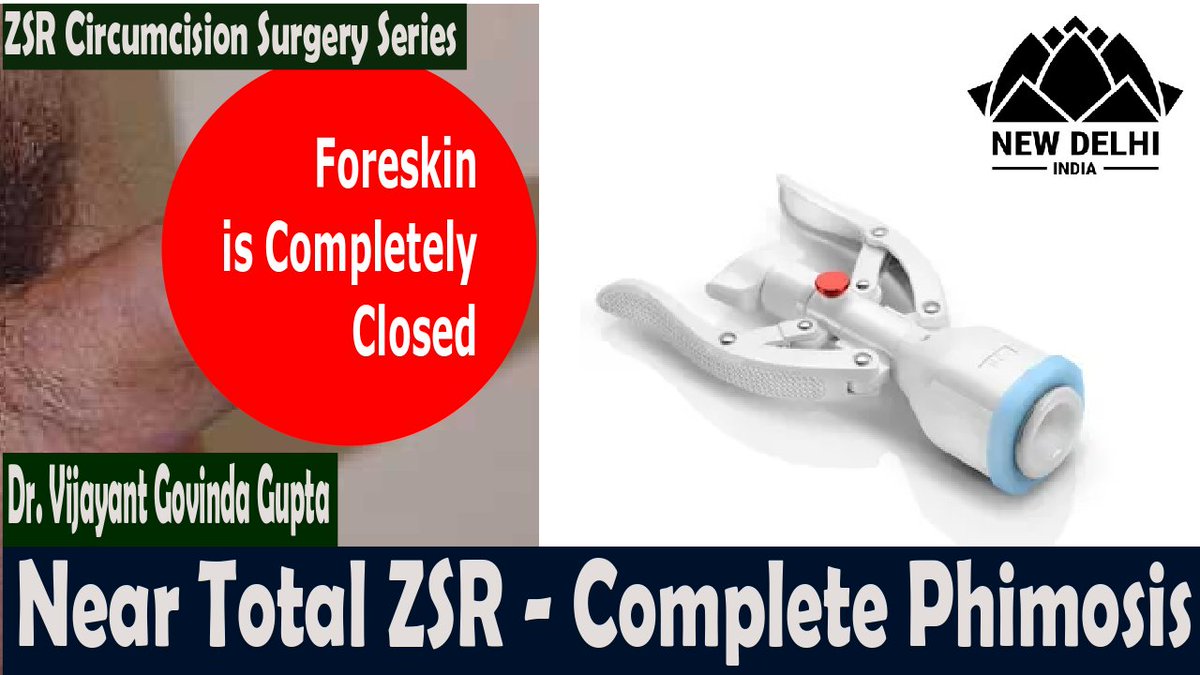 drvggupta's tweet photo. आज का वीडियो टोटल फिमोसिस में ZSR Circumcision
Todays Video ZSR Circumcision in Total phimosis
#phimosis #zsrcircumcision
ZSR ZSR INDIA ZSR Malaysia
https://t.co/osf40Ksiog https://t.co/ZMps9Npt1o