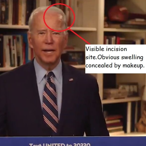 I'm a neurologist at St. Mark's Hospital and also a Joe Biden supporter. I just saw his recent live stream and I am concerned.

He's clearly recently had brain surgery, probably for a Cerebral Edema (swelling of brain fluid). My guess is that it was caused by untreated LGMA.