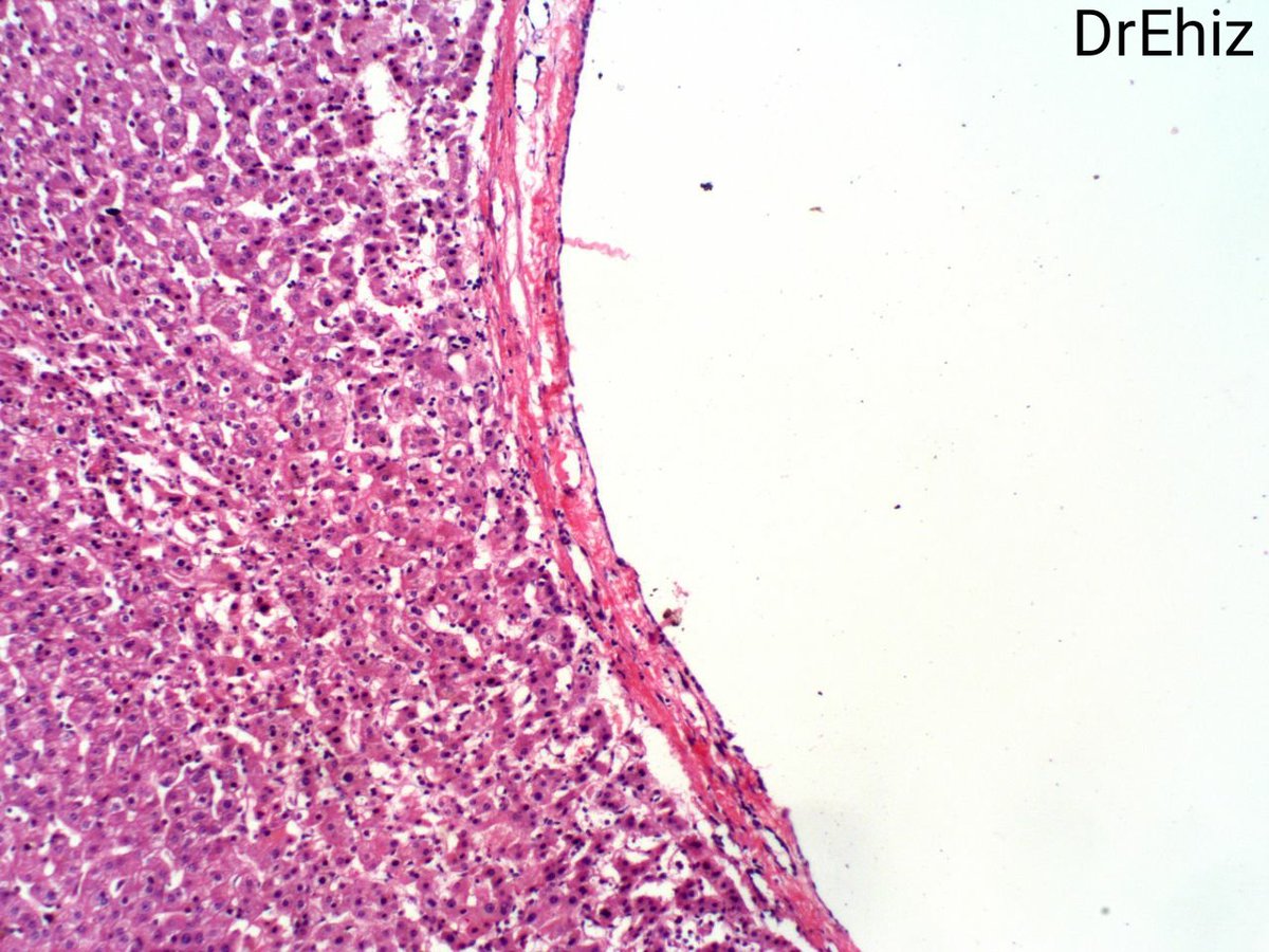 EhizDr's tweet photo. #GIpath #liverpath @RunjanChetty A liver nodule from a 50year old male. What are your thoughts? https://t.co/kucz5jlsYO