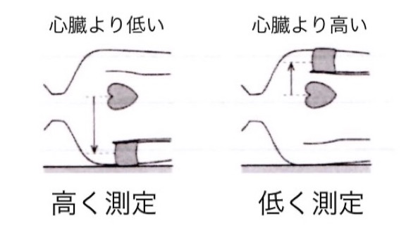 Hiro Maeda フィジカルアセスメント 血圧計のカフは心臓の位置に合わせ 側臥位での測定には注意が必要です なぜなら 心臓より低いと高く測定され 高いと低く測定されることがあるからです 特に体位ドレナージ 側臥位 の際は 正確に測定できていない