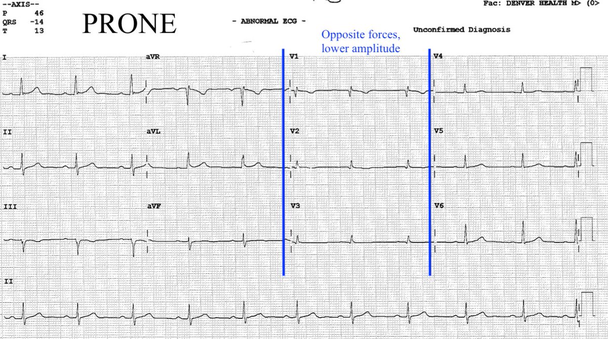 Maybe small potatoes but curious: when tele won't cut it, how are we doing ECGs in #pronepositioning patients? From a non-tweeting colleague, Mo Farasat: put the leads on the back (obviously) but not V7-V9. Check it out: pretty similar to supine. #Covid4MDs #Medtwitter #FOAMed