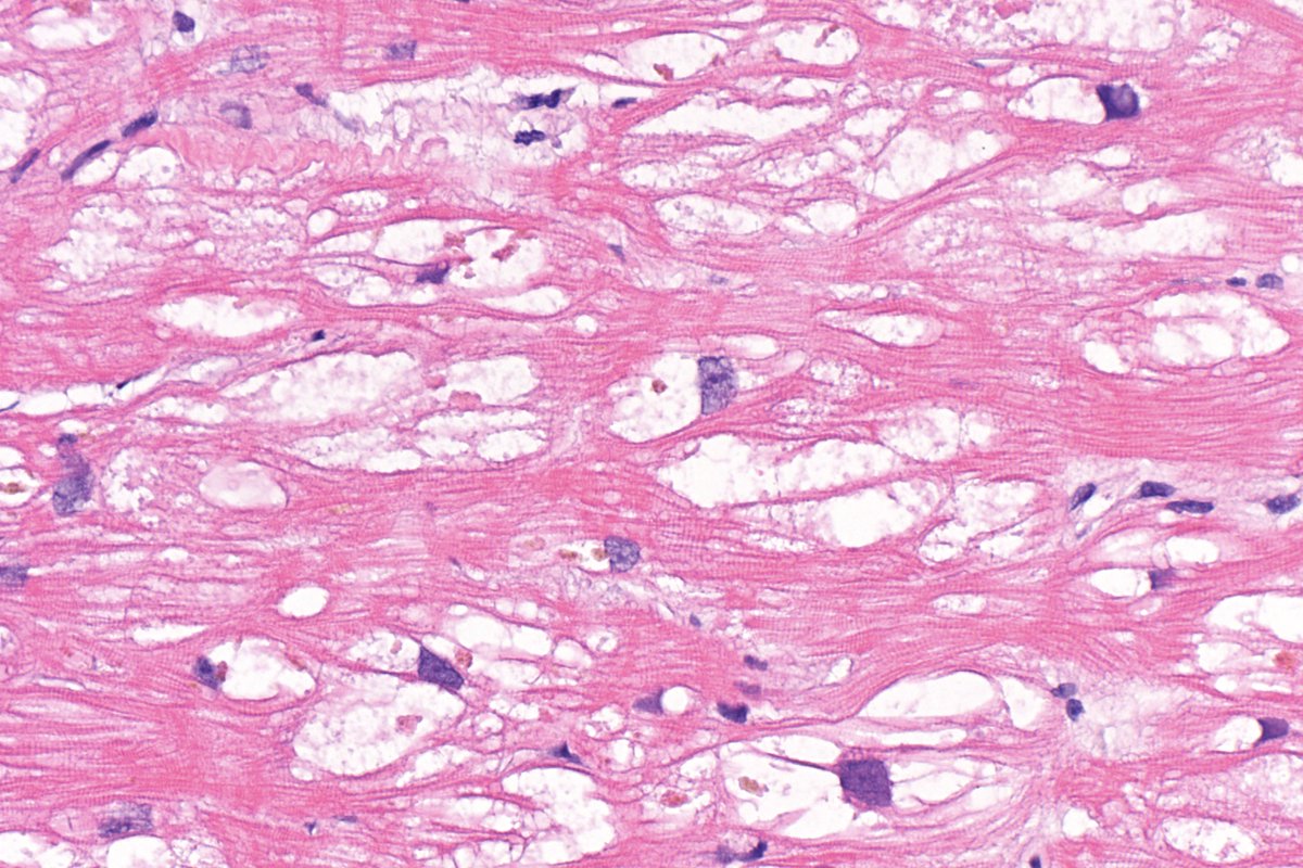 #Hydroxychloroquine ≠ benign drug. It can have devastating effect on heart muscle. On the left is normal myocardium. On the right is HcQ-mediated cardiotoxicity with prominent sarcoplasmic vacuolization. #CVPath