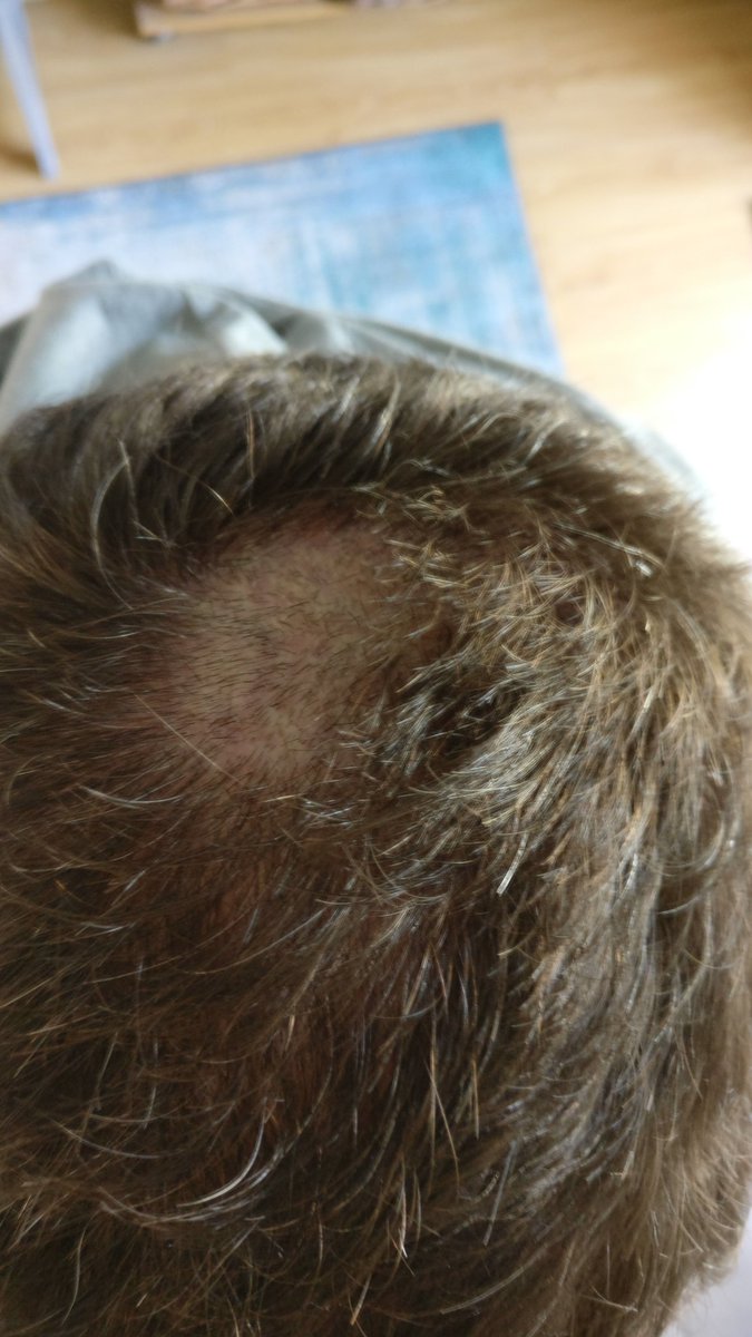 skyblueshaw's tweet photo. @campbellclaret This is what can happen. I believe my 'hairdresser' used the word 'shit', as it happened. https://t.co/WfgQmYLozQ