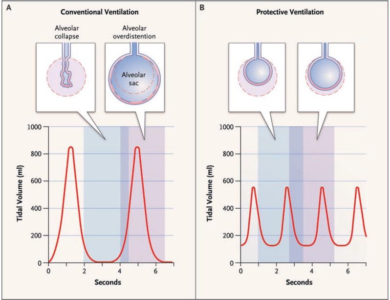 4/ You'll need to set minute ventilation (MV = tidal volume x respiratory rate)-Try to approximate pre-intubation MV (not always possible)-Use low tidal volume ventilation (4-8 ml/kg ideal body weight)-Goal plateau pressure < 30 mmHg-Goal pH > 7.2 https://www.ncbi.nlm.nih.gov/pubmed/17855672 