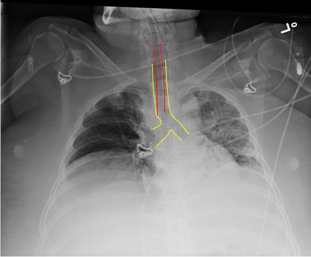 2/ First, confirm endotracheal tube position:- Did capnography confirm tracheal placement?- Are breath sounds bilateral?- Is the tube placed appropriately on CXR? (typically 2-5 cm from carina) Pic from SAEM  https://bit.ly/3bJrTpa 