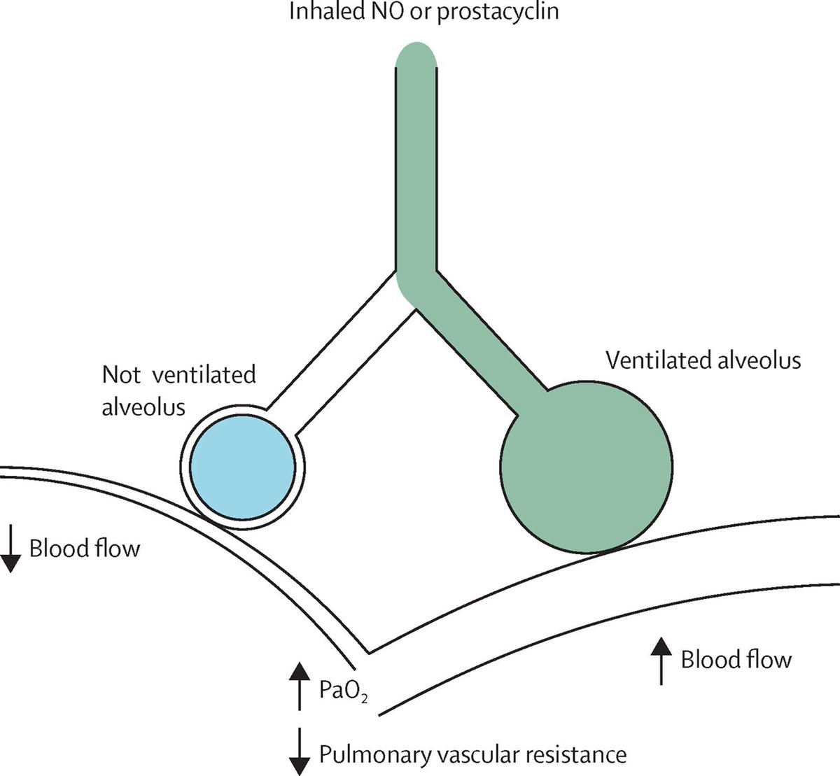 10/ What are ex. of inhaled pulmonary vasodilators?Epoprostenol or nitric oxide- Preferentially vasodilate aerated lung units,  V/Q matching and  SpO2- No impact on mortality or lung mechanics so should only be added for refractory hypoxemia https://www.ncbi.nlm.nih.gov/pubmed/27203510 