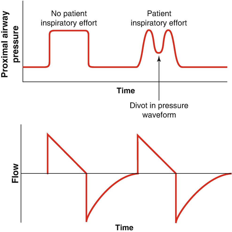 6/ Now that the ventilator's set, choose a sedation strategy.- Patients with moderate to severe ARDS usually need sedation to ensure vent synchrony- Vent Dyssynchrony  oxygenation and  lung injury- Whatever sedation you choose, achieve synchrony https://link.springer.com/chapter/10.1007/978-3-319-89981-7_7