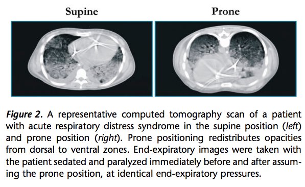 9/ Benefits of proning?Turning patients to the prone position optimizes V/Q matching and lung recruitment, and may dramatically improve hypoxemia.It has been shown to reduce mortality in those with PaO2:FiO2 < 150. https://www.ncbi.nlm.nih.gov/pubmed/24134414 