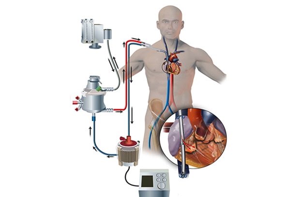 11/ Finally, when to call the veno-venous ECMO team.There's no hard/fast rule but this is reserved for patients w/ refractory severe hypoxemia or respiratory acidosis despite conventional therapies.A general rule is "it's better to call for ECMO too early than too late."