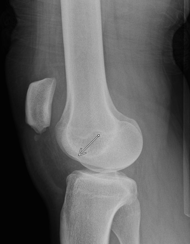 靭帯断裂の場合はどのような練習ができますか?