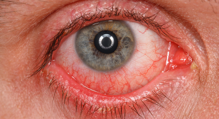 PCH_SF's tweet photo. Two emerging telltale #COVID19 symptoms that everyone should know about: 1)Eyes hurt [30%] 2)Can't smell (#anosmia) or taste (#ageusia) [>50%]. Add that to the triad of #fever #shortnessofbreath #cough that we know so well. @CarlosdelRio7's AM screen-take temp &amp; smell coffee https://t.co/9X0D4yssj6