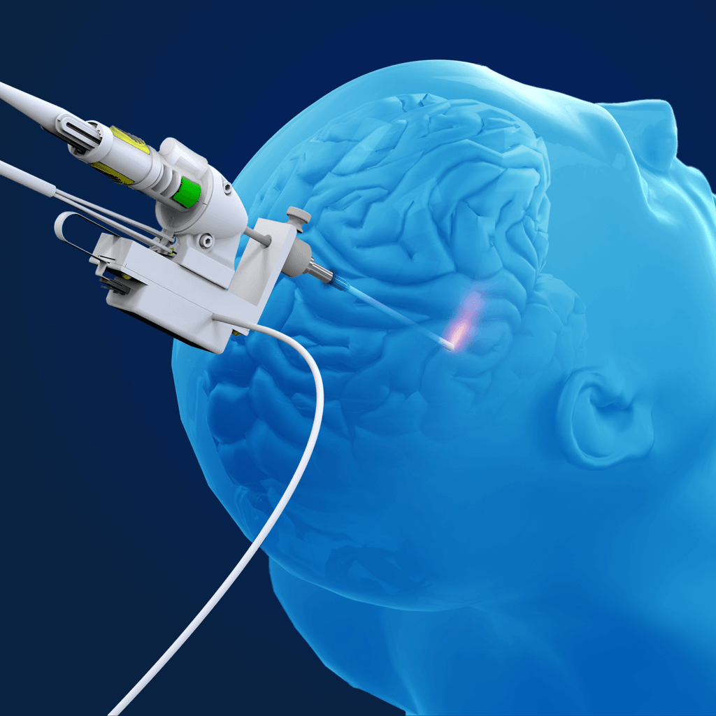 Neurocirugia La Fe on Twitter "Laser Ablation of Abnormal Neurological