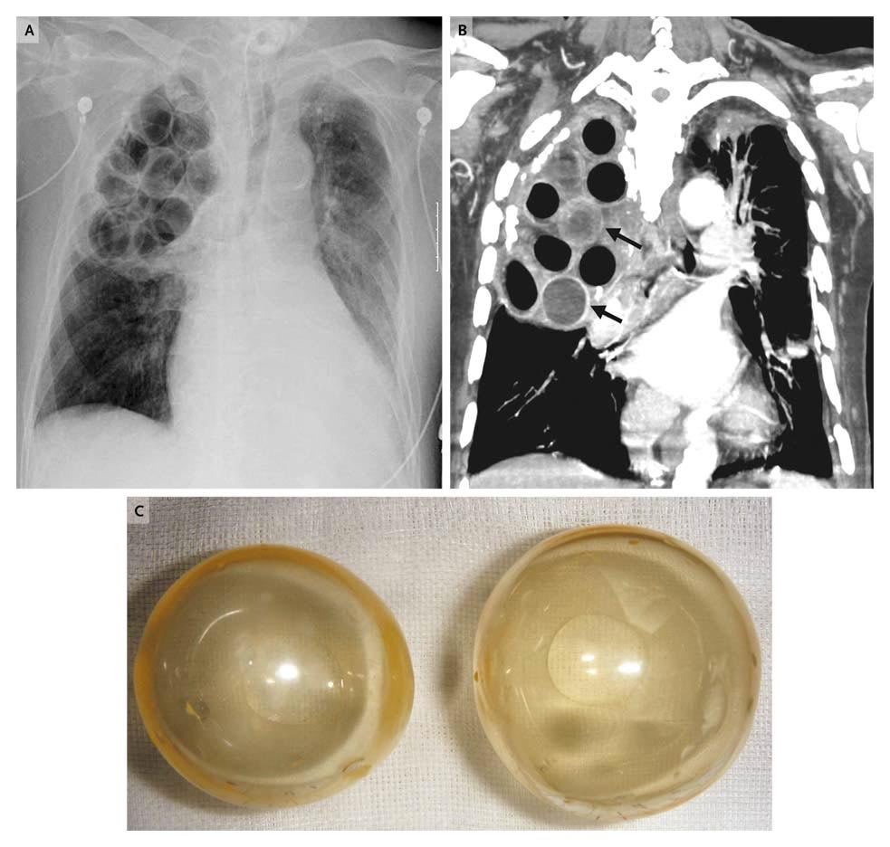 Plombage, o llenar la cavidad pleural de esferas de lucita. Una técnica que difícilmente a día de hoy se vea tras una radiografía de tórax convencional. 

Imagen cortesia de <a href="/NEJM/">NEJM</a> #SoMe  #SoMe4CT