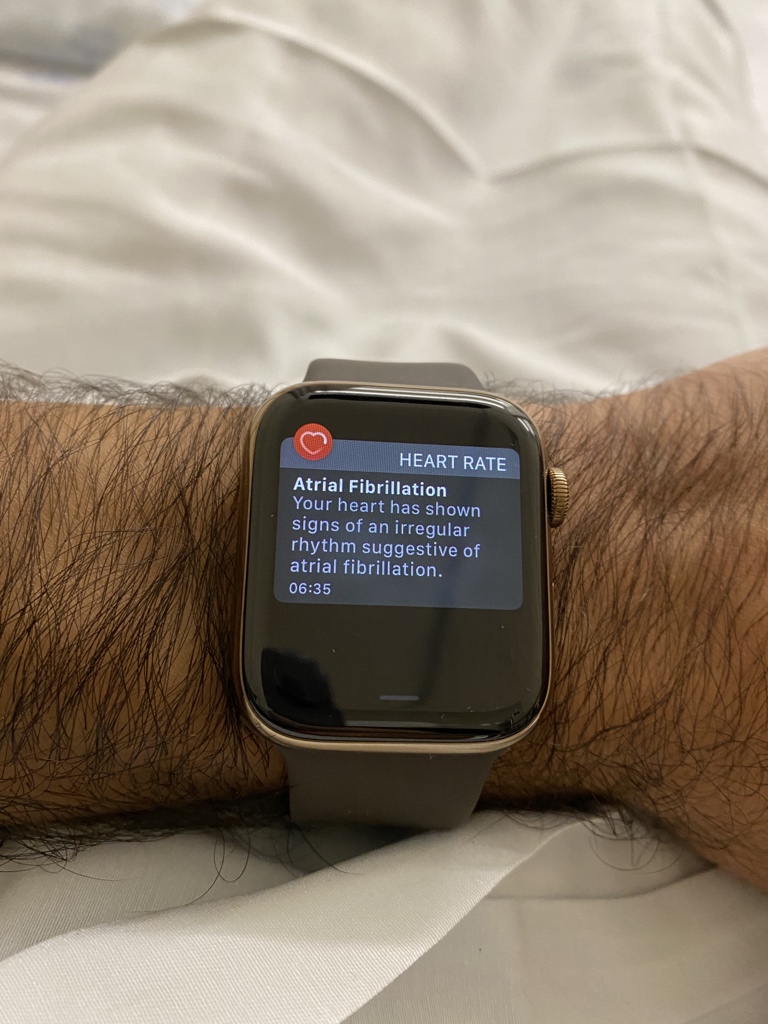 mvcmendes's tweet photo. Hj o Apple Watch me acordou às 6h35 com um aviso de AFib. Fui pro hospital e estava mesmo com arritmia.

(Tá tudo bem.)

Por sorte, ativei o Watch nos EUA e tenho o ECG. Ele leu isso sozinho enquanto eu dormia e me acordou pra ir cuidar. Que Anvisa e Apple liberem isso logo aqui. https://t.co/yuzsi2BhiW