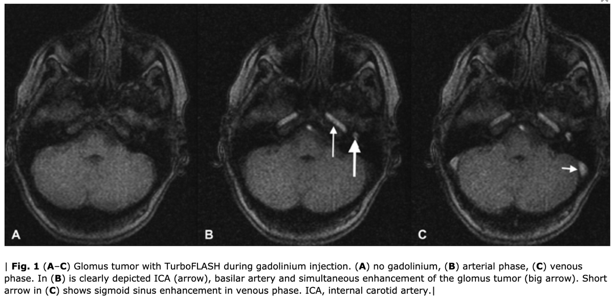 NASBSorg's tweet photo. #JNLSB_Online Evaluation of Skull Base Tumors with Dynamic TurboFLASH MRI during Gadolinium Injection #nsgy #ent #skullbase #neurorads #differential #diagnosis #glomus #MRI #TurboFLASH
https://t.co/PMMohhAowA https://t.co/AL67XMuIEy