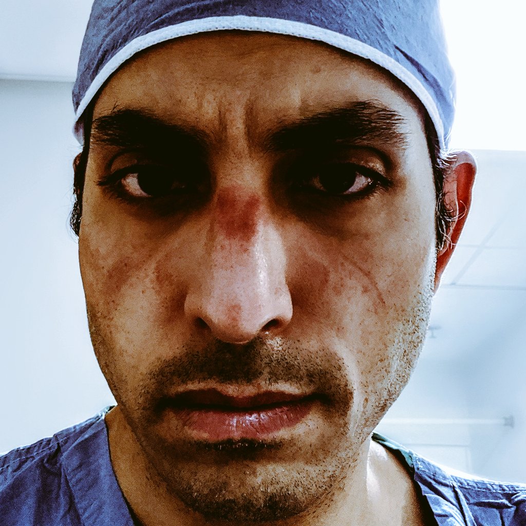 sharpsurgeon's tweet photo. #N95masks keep #HCW safe in these uncertain times of #COVID19 #coronavirus . My #NewProfilePic of a #BruisedFace is probably going to be the new norm for #doctors for the foreseeable future.
#givemeppe
@hayfarani @CMichaelGibson @Trustursurgeon @doctordave2 @NeilFlochMD https://t.co/XM4BCxtRTI