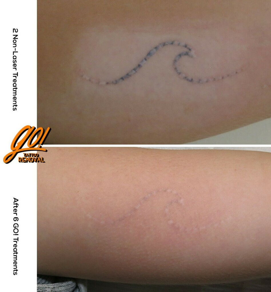 Can tattoos be removed by lasers permanently and without scarring Quora #21 Can tattoos be removed by lasers permanently and without scarring Quora