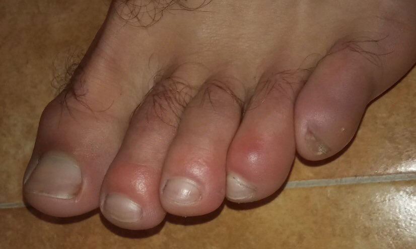 drpabloortiz's tweet photo. Otra consulta de #teledermatología. Varón joven, con contacto estrecho con paciente #COVID19 , mínima tos, no fiebre. Colegas internacionales están viendo casos similares con #coronavirus confirmado. 
#dermatología. https://t.co/iLxhyQVKUb