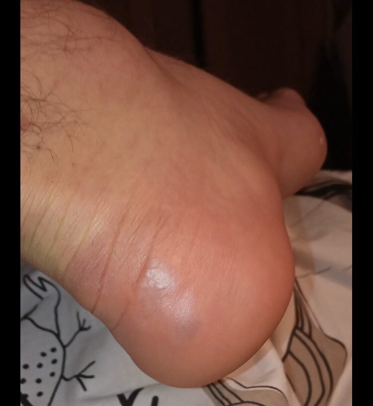 drpabloortiz's tweet photo. Otra consulta de #teledermatología. Varón joven, con contacto estrecho con paciente #COVID19 , mínima tos, no fiebre. Colegas internacionales están viendo casos similares con #coronavirus confirmado. 
#dermatología. https://t.co/iLxhyQVKUb