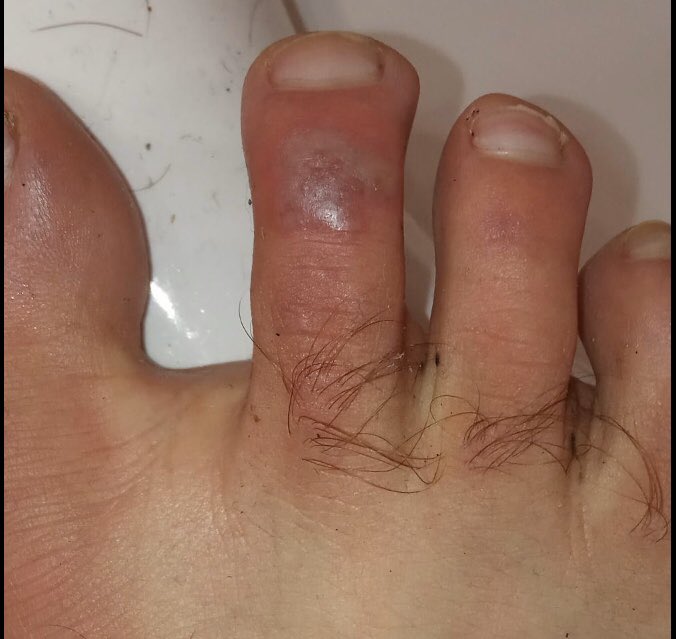 drpabloortiz's tweet photo. Otra consulta de #teledermatología. Varón joven, con contacto estrecho con paciente #COVID19 , mínima tos, no fiebre. Colegas internacionales están viendo casos similares con #coronavirus confirmado. 
#dermatología. https://t.co/iLxhyQVKUb
