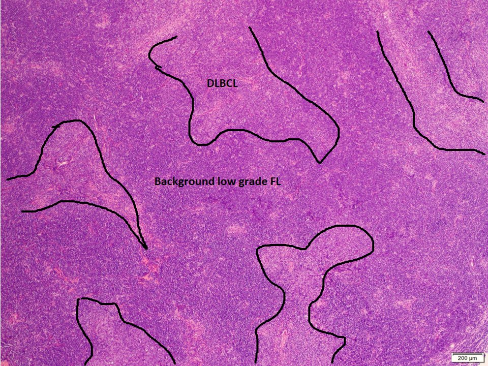 (1/3) Mutlifocal DLBCL arising in a background of low grade follicular lymphoma, with a peculiar architecture  #hemepath  #LJMFridayUnknowns  #VirtualHemepathMDA  #lymsm  #endcancer